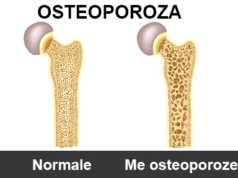 Osteoporoza, një sëmundje e heshtur. Shkaqet dhe trajtimi