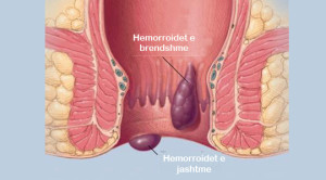 Hemorroidet