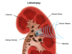Simptomat dhe Kurimi i Gureve ne Veshka.