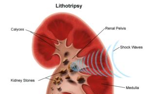 Simptomat dhe Kurimi i Gureve ne Veshka.