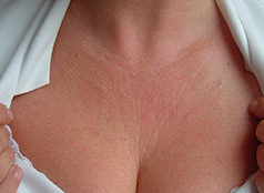 Rudhat në pjesën e kraharorit, si ti parandalojme!