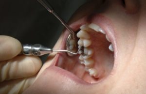 Semundja e mishit te dhembeve mund te jete shenje e Alzheimerit