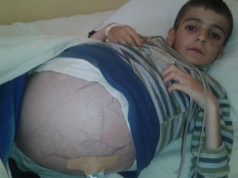 10-vjecari me nje semundje te rralle. Familjaret apel per ndihme