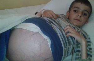 10-vjecari me nje semundje te rralle. Familjaret apel per ndihme