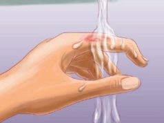 Si te veprojme ndaj djegieve