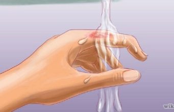 Si te veprojme ndaj djegieve