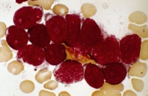 A mund te jete kjo kura ndaj kancerit?