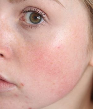 Si te trajtojme fytyrat me kapilare