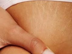 Strijat dhe menyrat e trajtimit