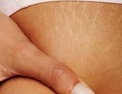 Strijat dhe menyrat e trajtimit