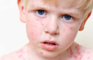 OBSH jep alarmin per fruthin