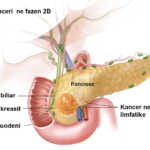 kanceri-pankreas