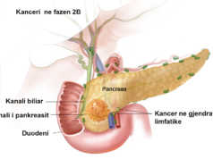 Kanceri i pankreasit, ja pse eshte shume i rrezikshem pankreasi