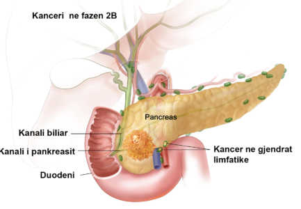 Kanceri i pankreasit, ja pse eshte shume i rrezikshem pankreasi