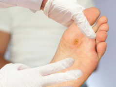 Myku i kembeve, ekzema dhe kallot, ja si ti kurojme