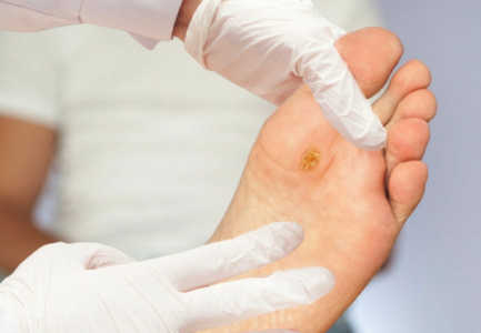 Myku i kembeve, ekzema dhe kallot, ja si ti kurojme