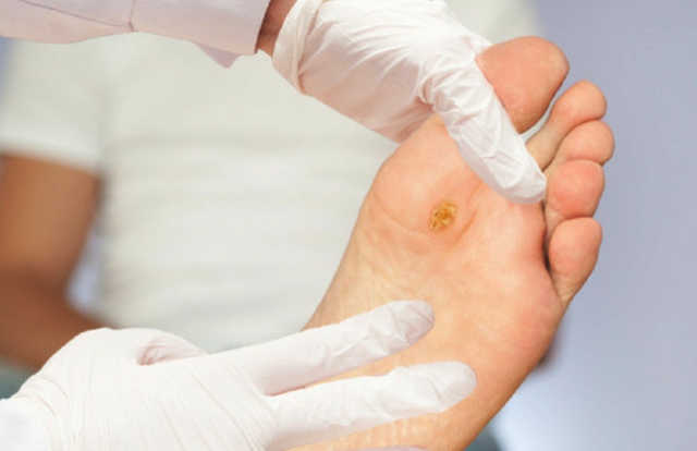 Myku i kembeve, ekzema dhe kallot, ja si ti kurojme