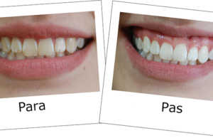 Zbardhja e dhembeve, ja cfare duhet te kemi parasysh