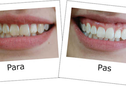 Zbardhja e dhembeve, ja cfare duhet te kemi parasysh