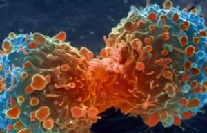 10 shenjat e kancerit që të gjithë i injorojmë!