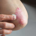 trajtimi-psoriasis
