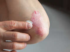 Çfare eshte psoriaza, simptomat dhe nga se shkaktohet