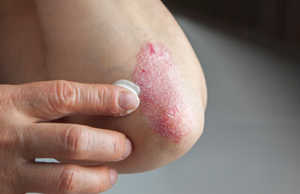 Çfare eshte psoriaza, simptomat dhe nga se shkaktohet