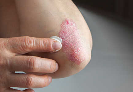 Çfare eshte psoriaza, simptomat dhe nga se shkaktohet