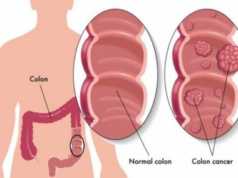 4 shenjat dalluese te kancerit te zorres