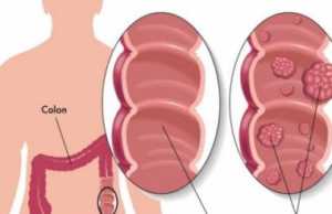 4 shenjat dalluese te kancerit te zorres