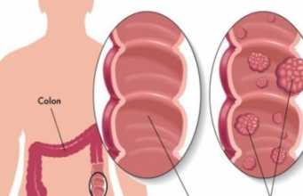 4 shenjat dalluese te kancerit te zorres