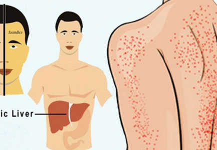 Shenjat paralajmeruese per problemet me melcine