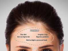 Harta e akneve ne fytyre