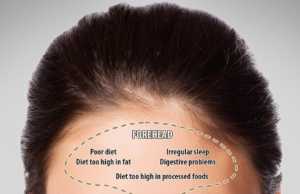 Harta e akneve ne fytyre