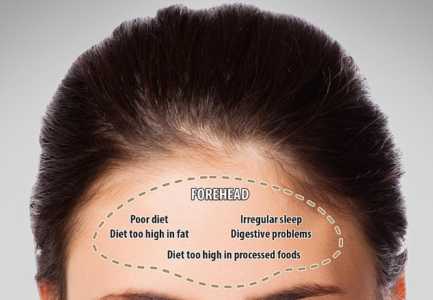 Harta e akneve ne fytyre